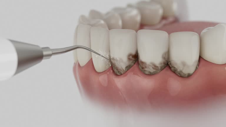 Trusted Wisdom Tooth Removal service in Unionville, GA - Dentist Open Now